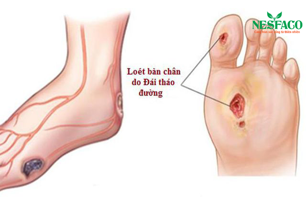 điều trị loét bàn chân