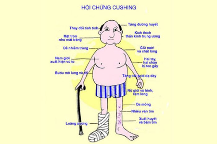 Hội chứng Cushing là tình trạng vỏ tuyến thượng thận bị rối loạn chức năng