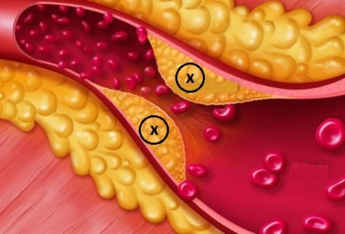 Rối loạn lipid máu là gì?