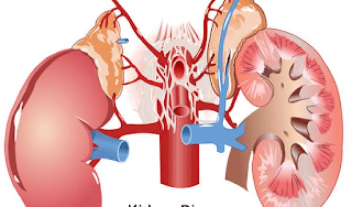 Nhiễm trùng thận là tình trạng các đài thận, nhu mô thận, niệu quản bị nhiễm khuẩn