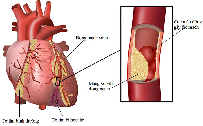 Người mắc tăng huyết áp có nguy cơ gặp các biến chứng nguy hiểm liên quan đến tim mạch