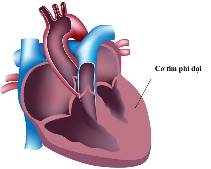 Phì đại thất trái là bệnh gì?