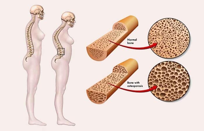 Loãng xương là biến chứng thường gặp ở người bệnh tiểu đường