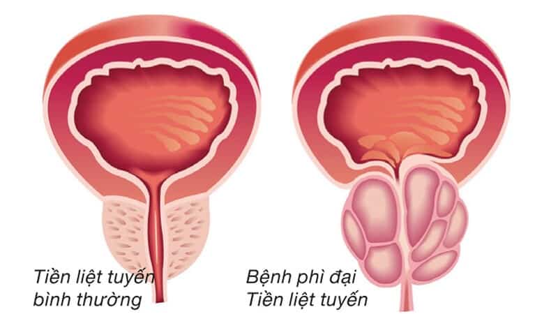 Bệnh lý tuyến tiền liệt có thể gây đái ra máu