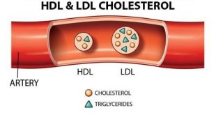 chỉ số LDL cholesterol trong máu là gì