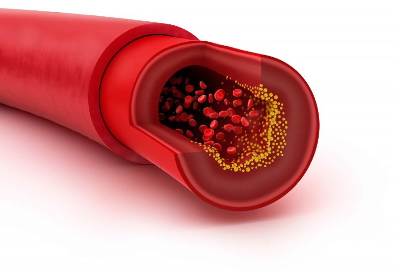 chỉ số LDL cholesterol trong máu là gì 