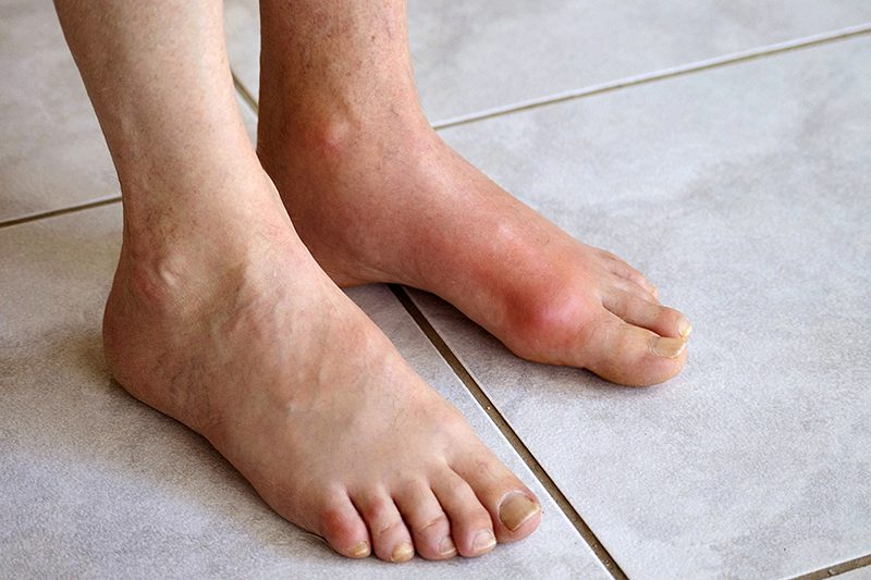 Bệnh gout thường gặp ở đàn ông từ 40 tuổi trở lên