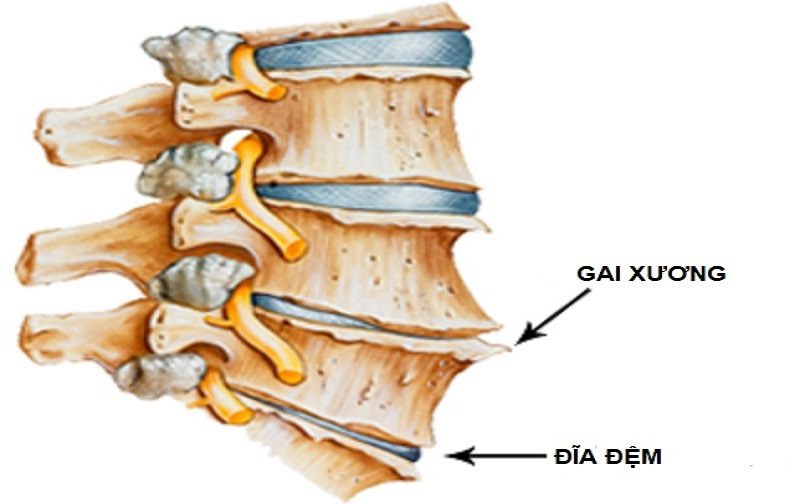 Gai xương gây cọ xát các xương và mô khác dẫn đến cảm giác đau